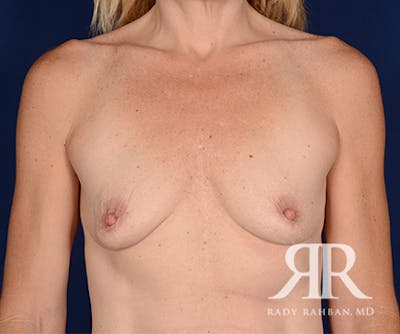 Breast Augmentation Before & After Gallery - Patient 260105 - Image 1