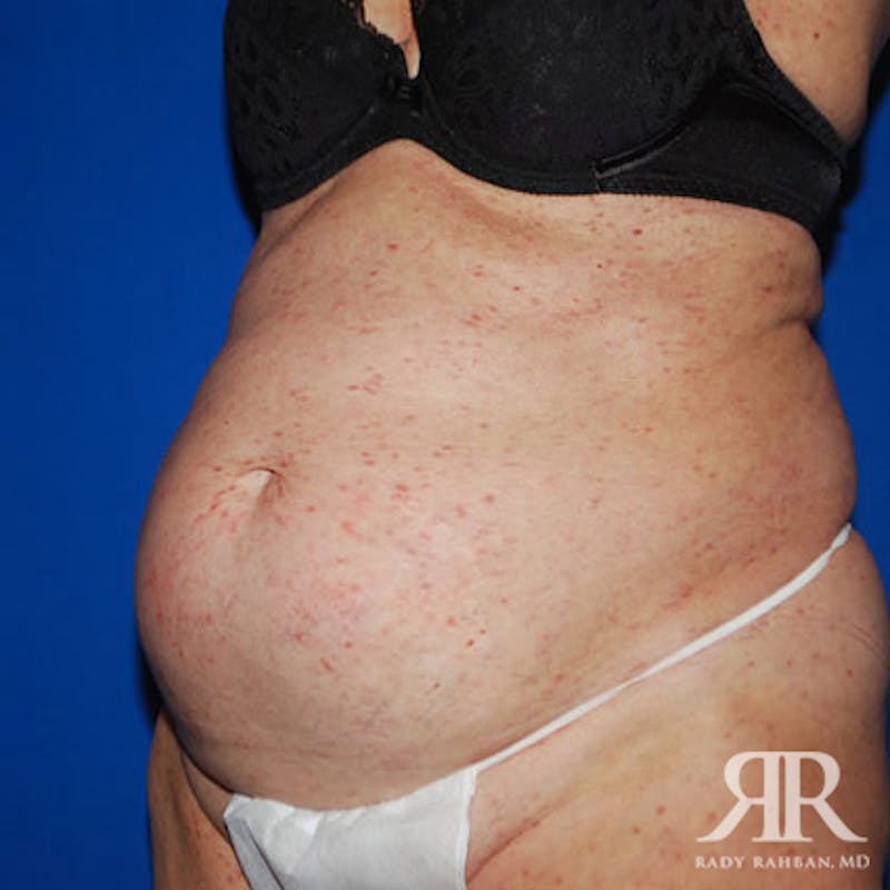 Tummy Tuck Before & After Gallery - Patient 472999 - Image 3