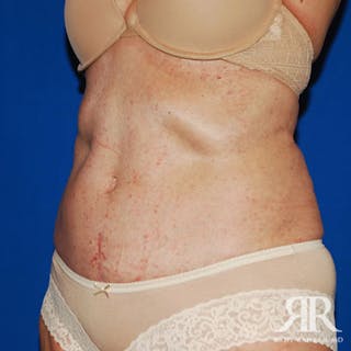 Tummy Tuck Before & After Gallery - Patient 472999 - Image 4