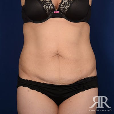 Tummy Tuck Before & After Gallery - Patient 179611 - Image 1