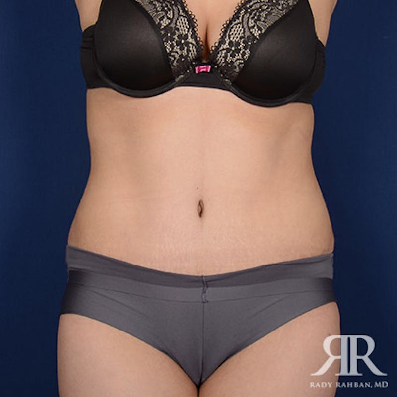 Tummy Tuck Before & After Gallery - Patient 179611 - Image 2