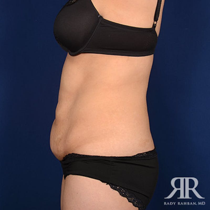 Tummy Tuck Before & After Gallery - Patient 179611 - Image 5