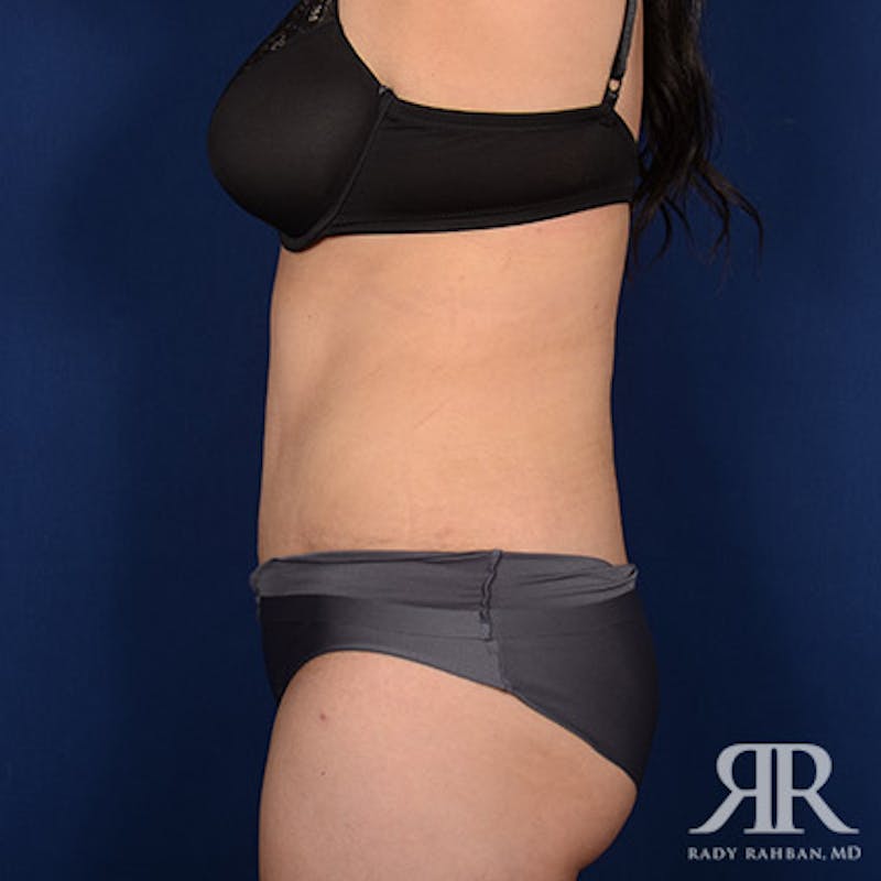 Tummy Tuck Before & After Gallery - Patient 179611 - Image 6
