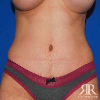 Tummy Tuck Before & After Gallery - Patient 314918 - Image 2