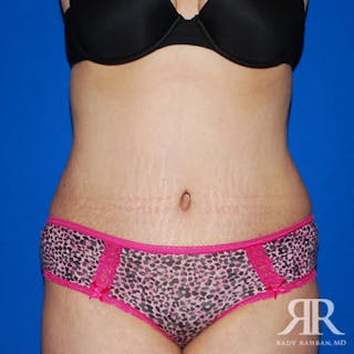 Tummy Tuck Before & After Gallery - Patient 609627 - Image 2