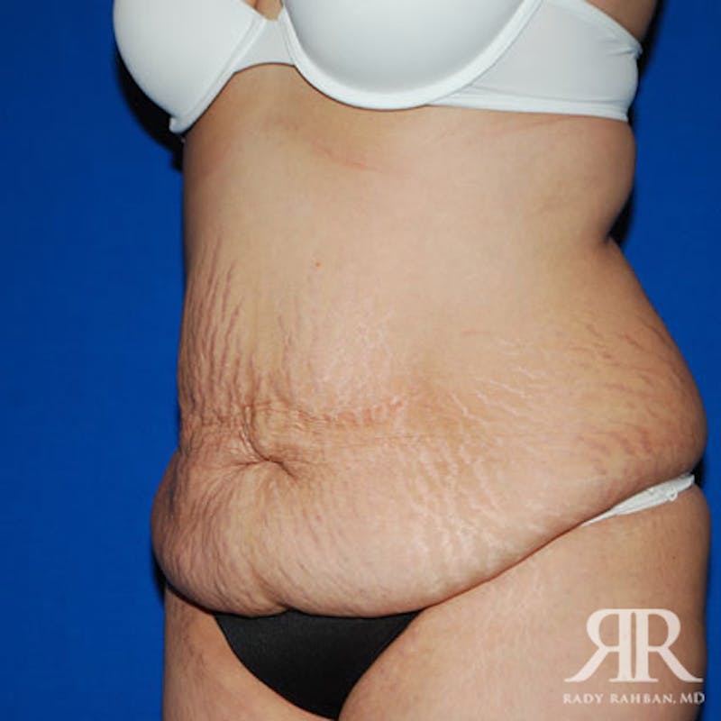 Tummy Tuck Before & After Gallery - Patient 609627 - Image 3