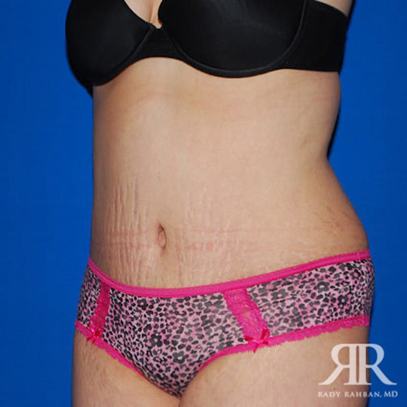 Tummy Tuck Before & After Gallery - Patient 609627 - Image 4