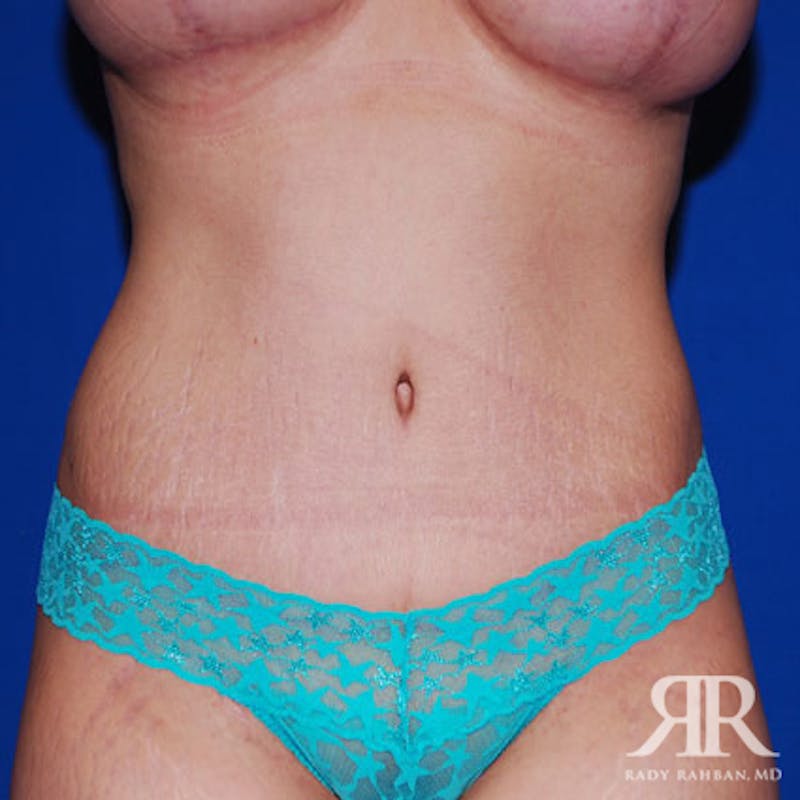 Tummy Tuck Before & After Gallery - Patient 109917 - Image 2