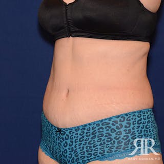 Tummy Tuck Before & After Gallery - Patient 108198 - Image 4