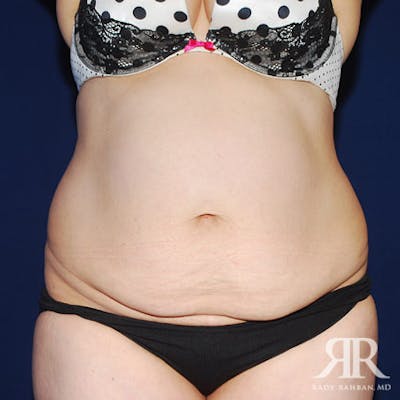 Tummy Tuck Before & After Gallery - Patient 165572 - Image 1