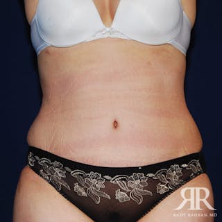 Tummy Tuck Before & After Gallery - Patient 165572 - Image 2