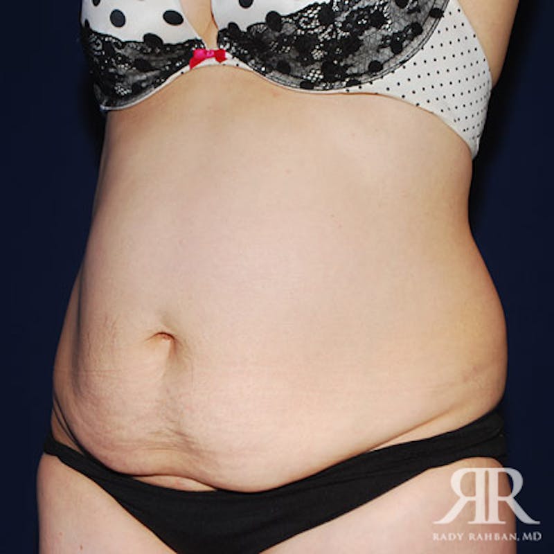 Tummy Tuck Before & After Gallery - Patient 165572 - Image 3