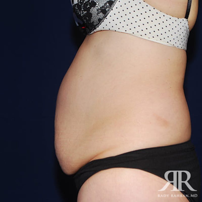 Tummy Tuck Before & After Gallery - Patient 165572 - Image 5