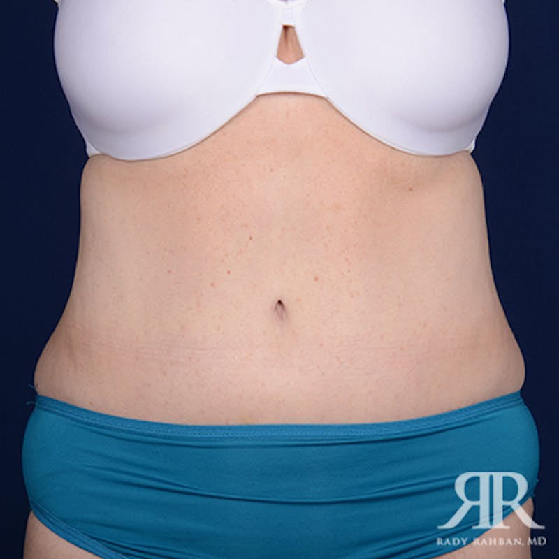 Tummy Tuck Before & After Gallery - Patient 350593 - Image 2
