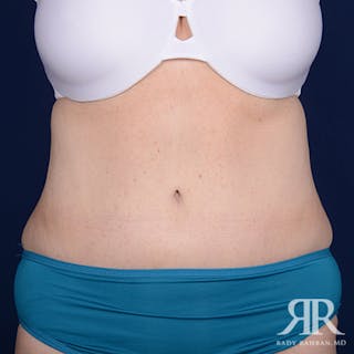 Tummy Tuck Before & After Gallery - Patient 350593 - Image 2