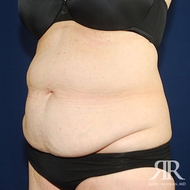 Tummy Tuck Before & After Gallery - Patient 350593 - Image 3
