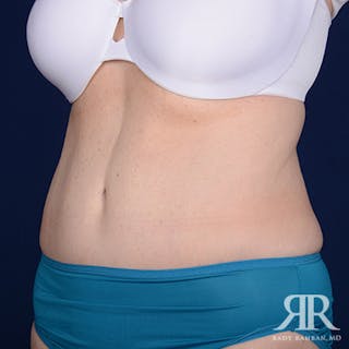 Tummy Tuck Before & After Gallery - Patient 350593 - Image 4