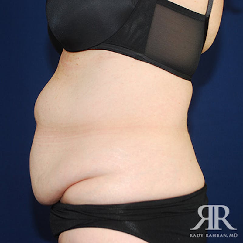Tummy Tuck Before & After Gallery - Patient 350593 - Image 5
