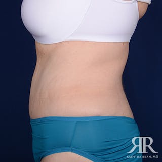 Tummy Tuck Before & After Gallery - Patient 350593 - Image 6