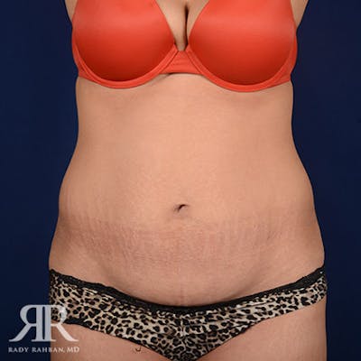 Tummy Tuck Before & After Gallery - Patient 140183 - Image 1