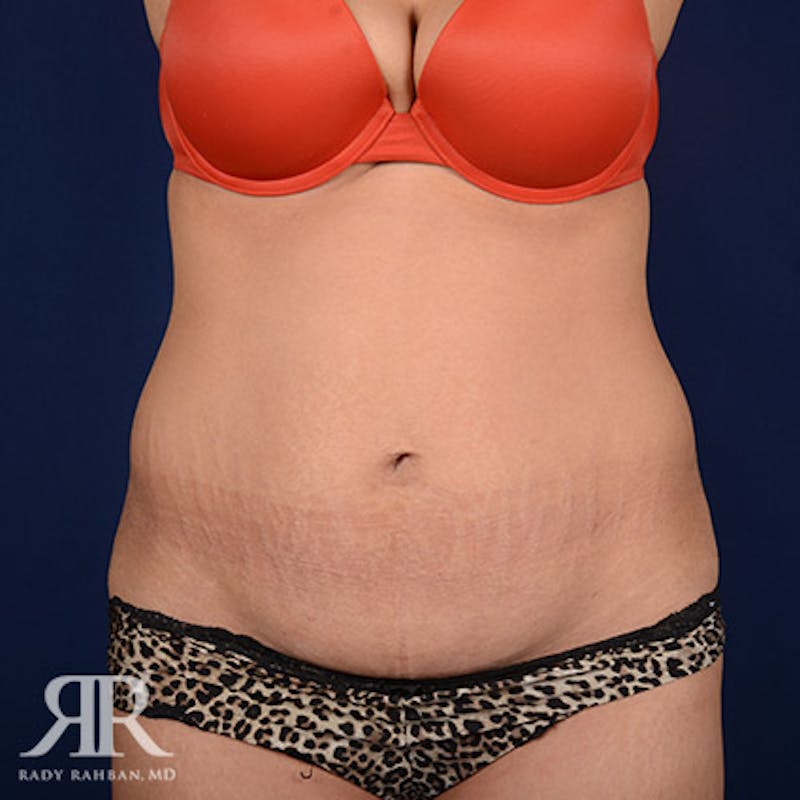 Tummy Tuck Before & After Gallery - Patient 140183 - Image 1