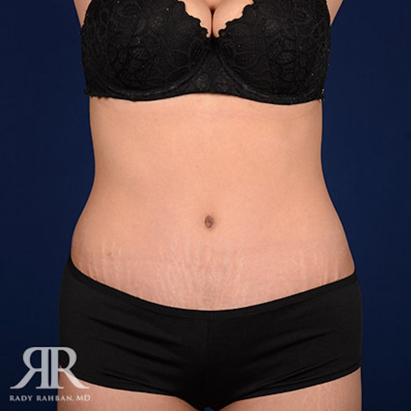 Tummy Tuck Before & After Gallery - Patient 140183 - Image 2