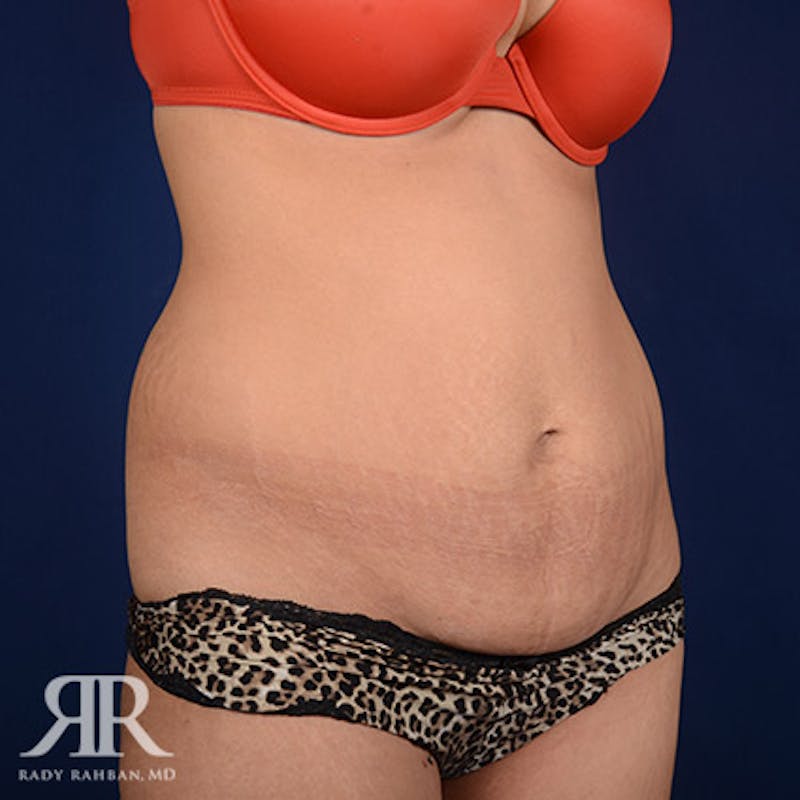 Tummy Tuck Before & After Gallery - Patient 140183 - Image 3