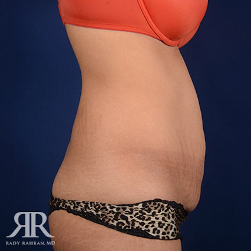 Tummy Tuck Before & After Gallery - Patient 140183 - Image 5