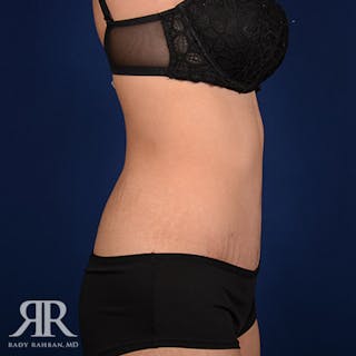 Tummy Tuck Before & After Gallery - Patient 140183 - Image 6