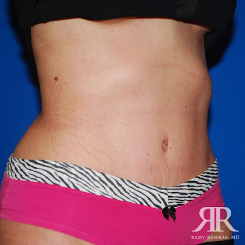 Tummy Tuck Before & After Gallery - Patient 177754 - Image 4
