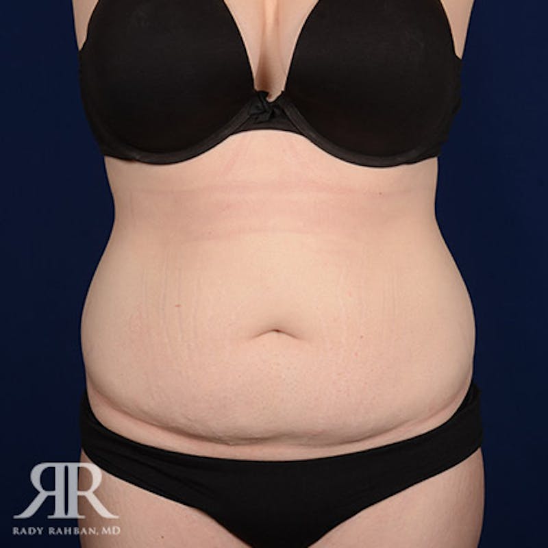 Tummy Tuck Before & After Gallery - Patient 100654 - Image 1