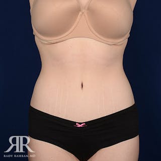 Tummy Tuck Before & After Gallery - Patient 100654 - Image 2