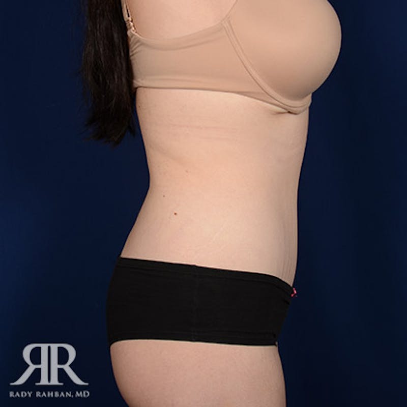 Tummy Tuck Before & After Gallery - Patient 100654 - Image 6