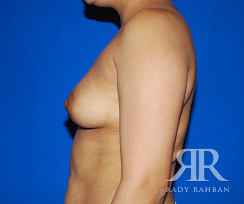 Breast Augmentation Before & After Gallery - Patient 266076 - Image 5