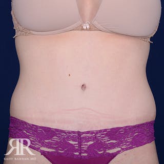 Tummy Tuck Before & After Gallery - Patient 210564 - Image 2