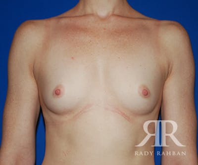 Breast Augmentation Before & After Gallery - Patient 332964 - Image 1