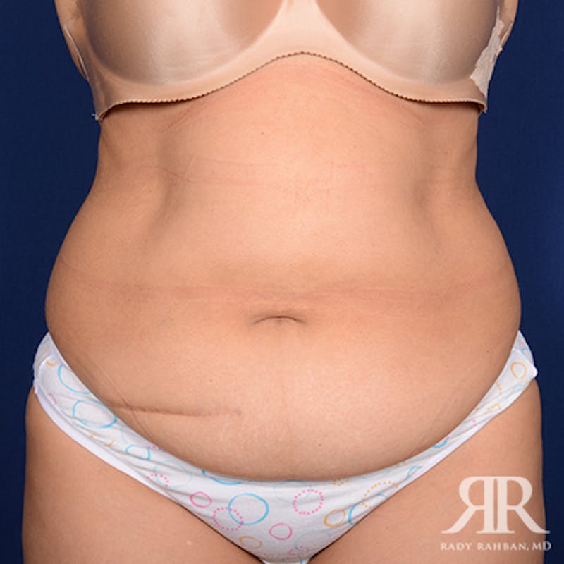 Tummy Tuck Before & After Gallery - Patient 259616 - Image 1