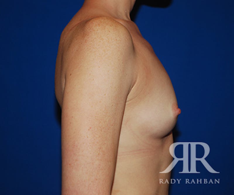 Breast Augmentation Before & After Gallery - Patient 332964 - Image 5
