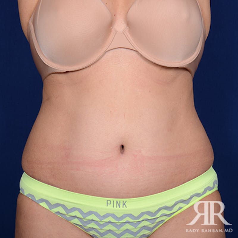 Tummy Tuck Before & After Gallery - Patient 259616 - Image 2
