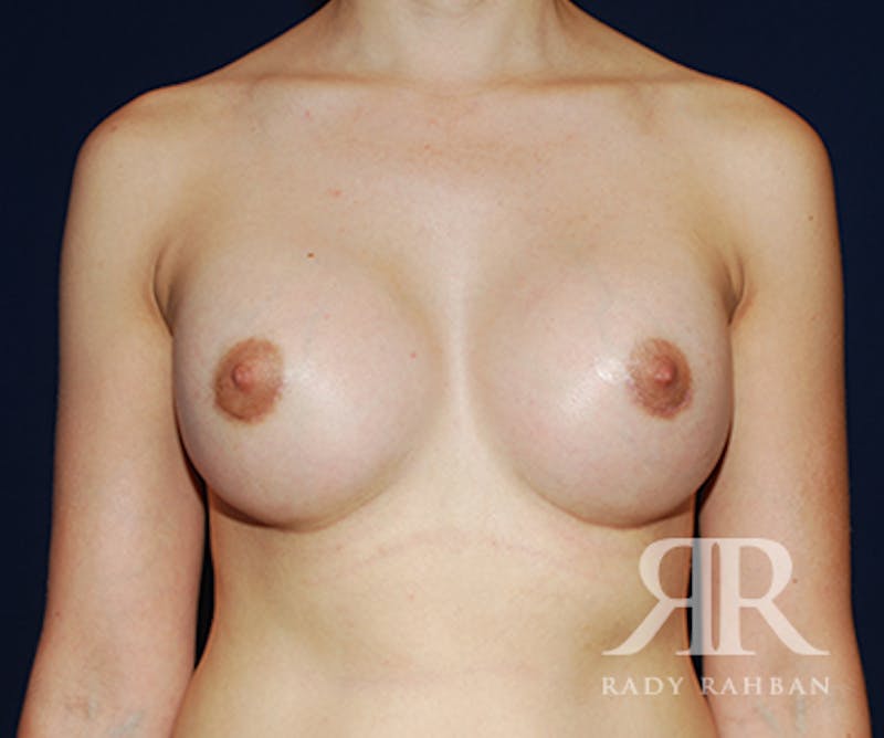 Breast Augmentation Before & After Gallery - Patient 108553 - Image 2