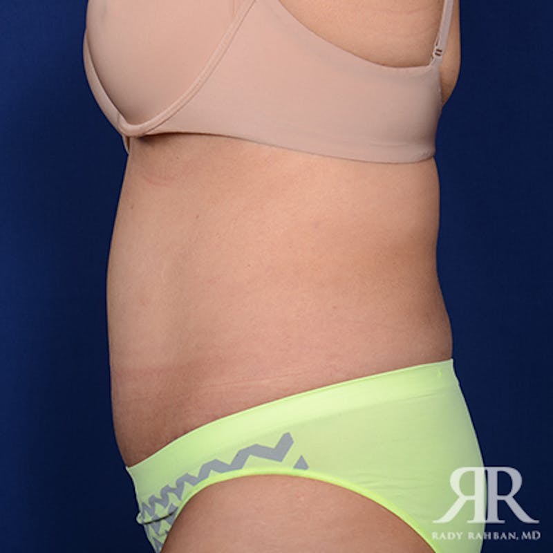 Tummy Tuck Before & After Gallery - Patient 259616 - Image 6