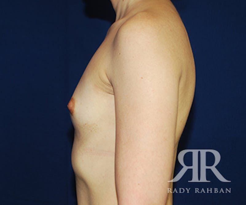 Breast Augmentation Before & After Gallery - Patient 108553 - Image 5