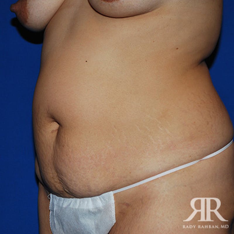 Tummy Tuck Before & After Gallery - Patient 210208 - Image 3