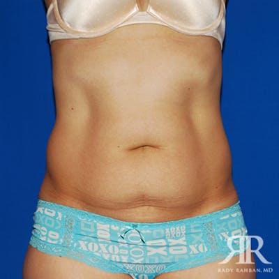 Tummy Tuck Before & After Gallery - Patient 193170 - Image 1