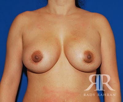 Breast Augmentation Before & After Gallery - Patient 383674 - Image 2