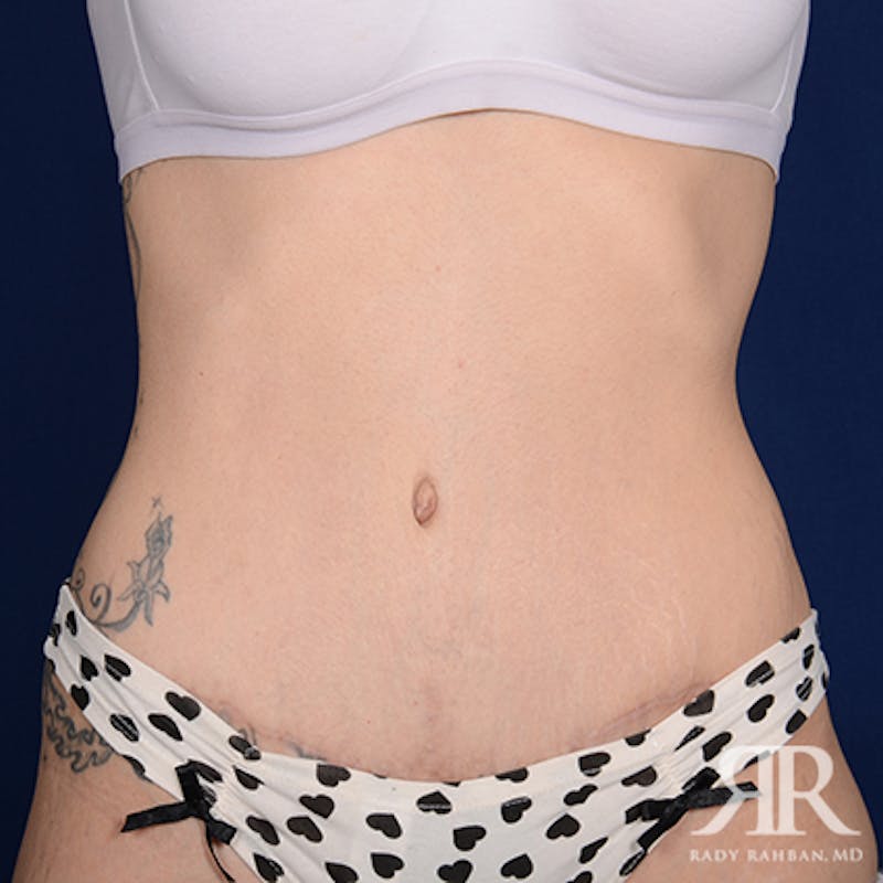 Tummy Tuck Before & After Gallery - Patient 265850 - Image 2