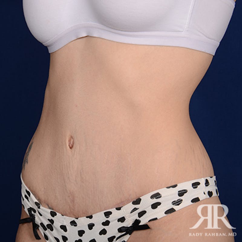 Tummy Tuck Before & After Gallery - Patient 265850 - Image 4