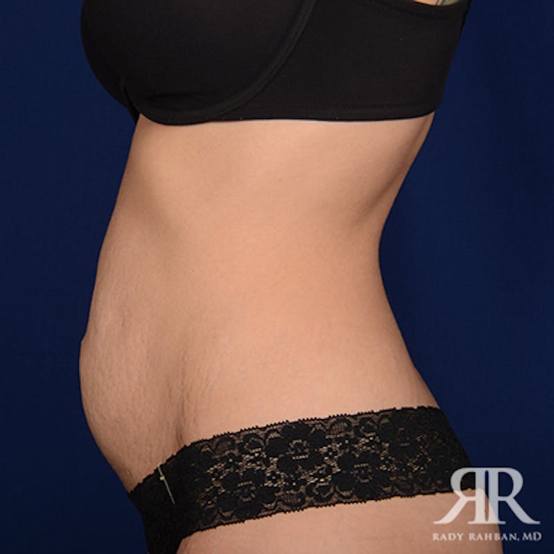 Tummy Tuck Before & After Gallery - Patient 265850 - Image 5