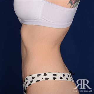 Tummy Tuck Before & After Gallery - Patient 265850 - Image 6