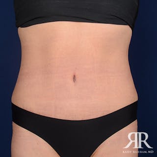 Tummy Tuck Before & After Gallery - Patient 275394 - Image 2